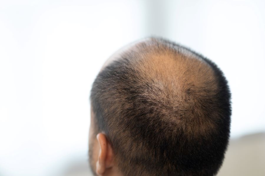 Back of balding man's head