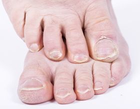 The Difference Between Nail Fungus and Psoriasis