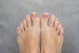 The Most Effective Treatments for Toenail Fungus