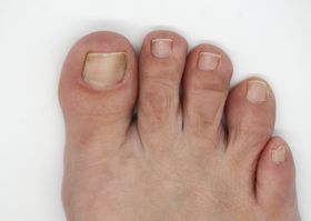 What Are the Most Common Causes of Fungal Toenail Infections?
