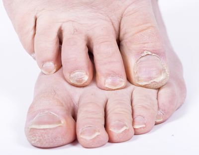 Damaged nails and psoriasis