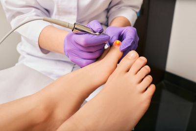 A doctor using a medical laser to treat a fungal infection of the nail