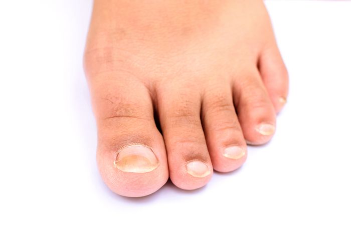 Fungal infection on a person's big toe