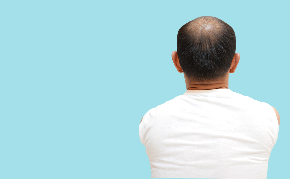 Man pictured from the back with thinning hair