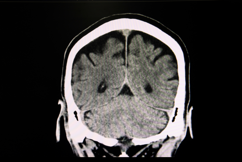 A CT scan of a patient with signs of moderate brain atrophy 