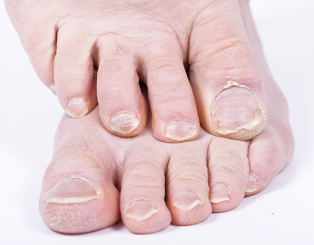 Damaged nails and psoriasis