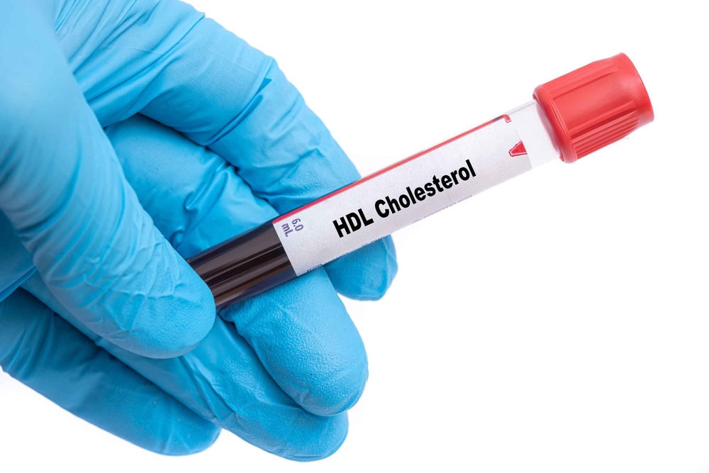 Hand of a doctor with gloves while holding a HDL Cholesterol test tube