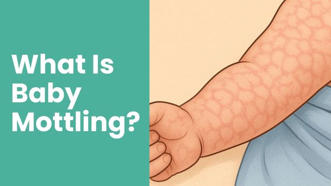 What Is Baby Mottling? Causes, Concerns, and When to Worry main image