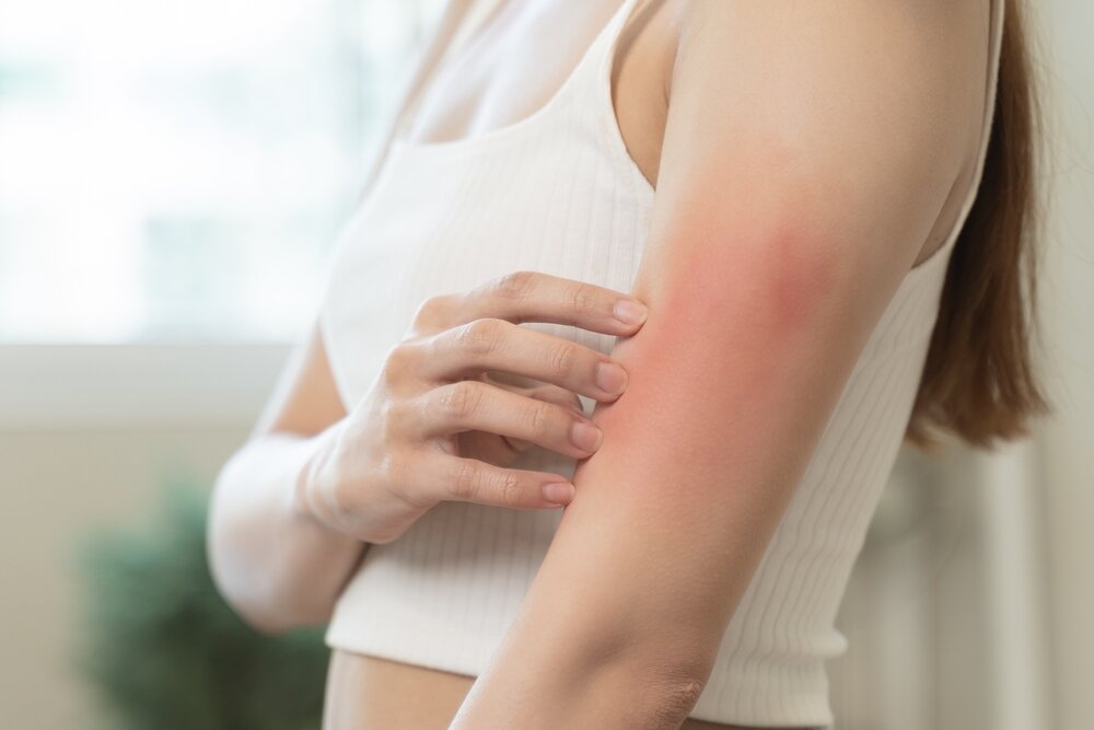 A woman scratching her arm, which is clearly irritated and red.