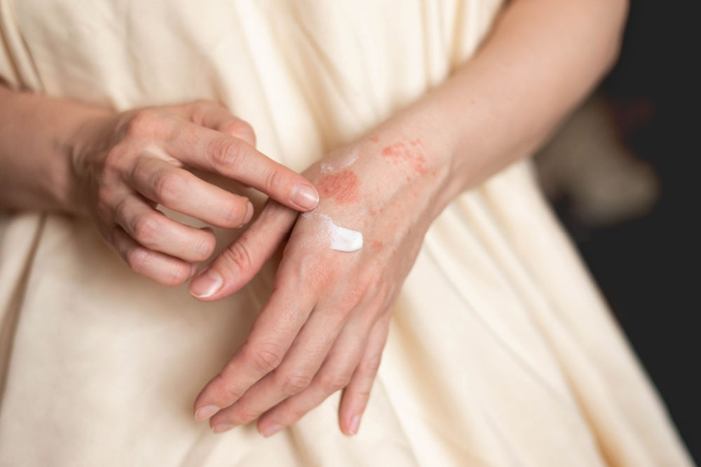 A woman applying cream on her hand, which features scaly and red skin.