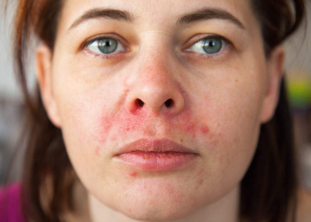Woman's face with dry and swollen inflamed skin caused by eczema-related stress