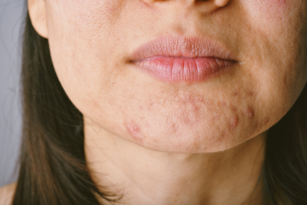 Woman's face with red and swollen acne breakout on her chin due to stress