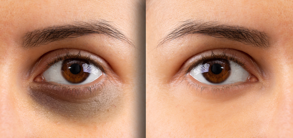 Before and after shot showing woman's under-eye bags from poor sleep compared to healthy and well-rested eyes