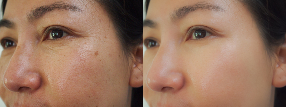 Before and after image showing wrinkles on a woman's face caused by stress