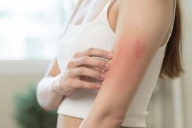 Stress Rash: 4 Home Remedies to Help Ease Your Discomfort