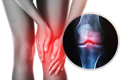 A woman holding her knee due to pain, signaled by a red light on her knee, with an image of her knee's xray next to it