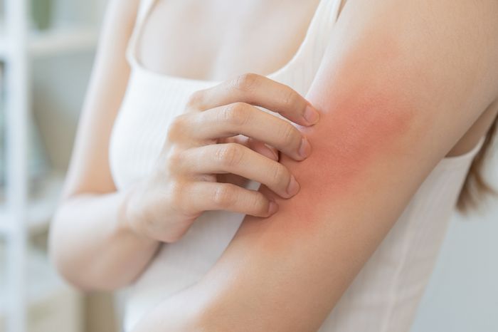Woman scratching a red spot on her arm