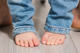 Pediatric Hammer Toe: Causes, Care, and Foot Development Tips