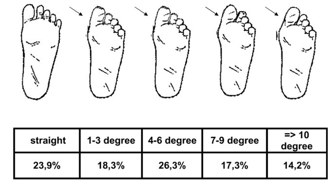 A diagram showing the Degrees of Hallux valgus in children.