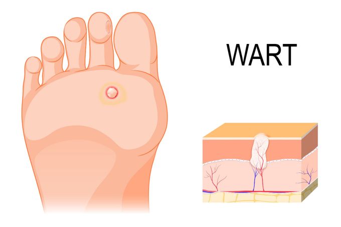 A diagram of a foot and a plantar wart