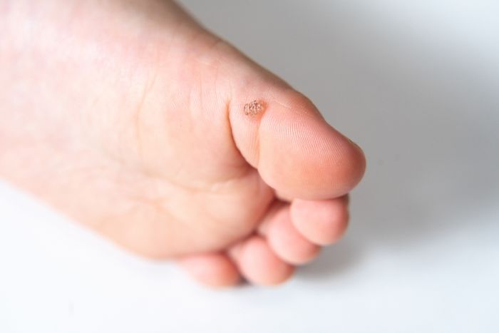 A. child's foot with a plantar wart on it.