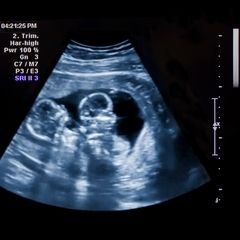 Pregnancy scan