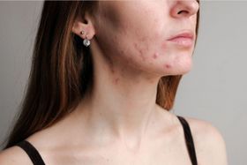 What Is Hormonal Acne? 3 Tips to Help Now