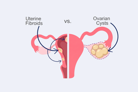 Ovarian Cyst vs Fibroid: The Ultimate Guide to Your Fertility