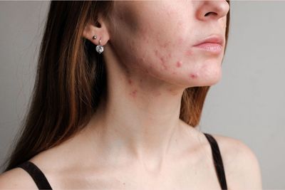 a woman with acne on her face