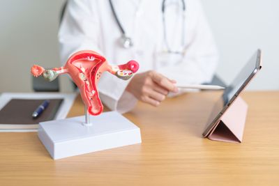 A doctor with a model of the uterus that has uterine fibroids.