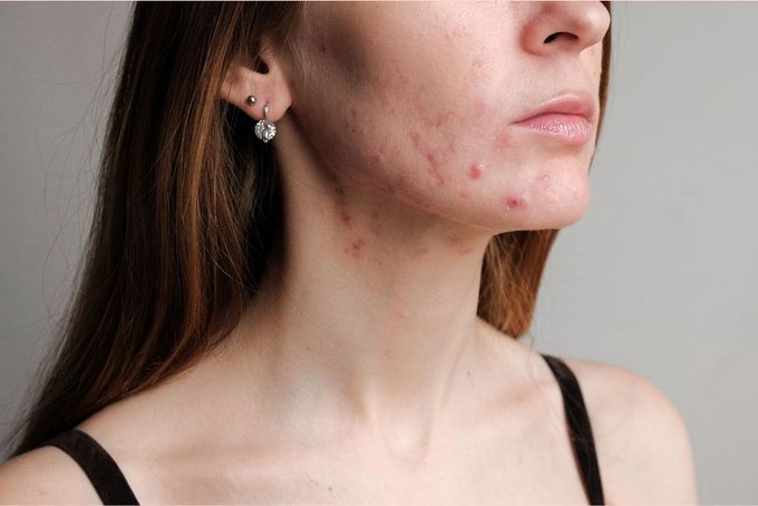 a woman with acne on her face