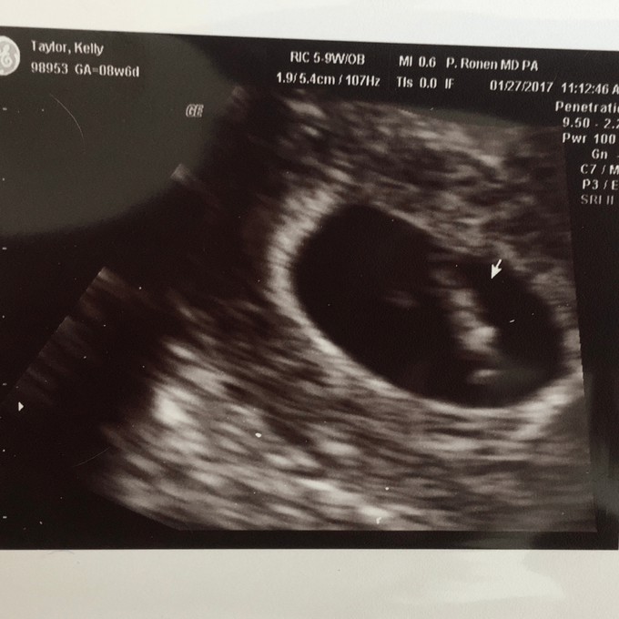 A baby scan of a woman with unexplained infertility