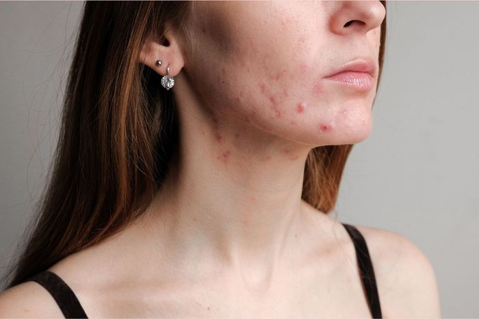 a woman with acne on her face