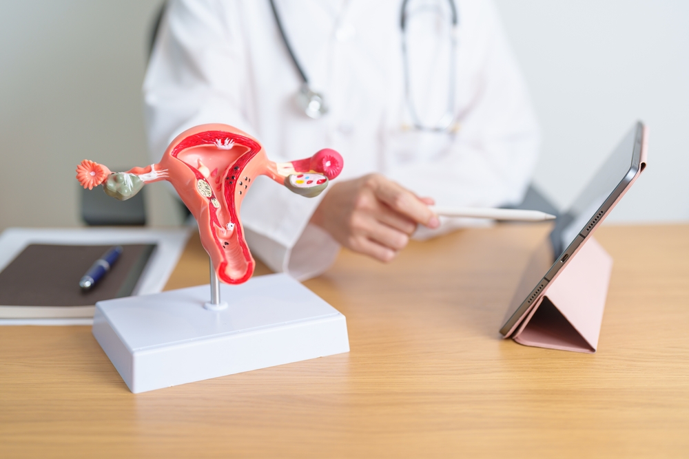 A doctor with a model of the uterus that has uterine fibroids.