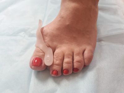 Foot with bunion corrector