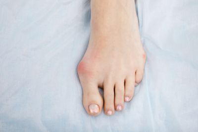Foot with bunions