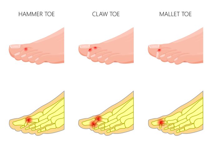 Diagram showing the difference between hammertoe, claw toe, and mallet toe