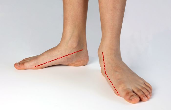 Person standing with outward facing flat feet  and dotted line showing the shape of the arch