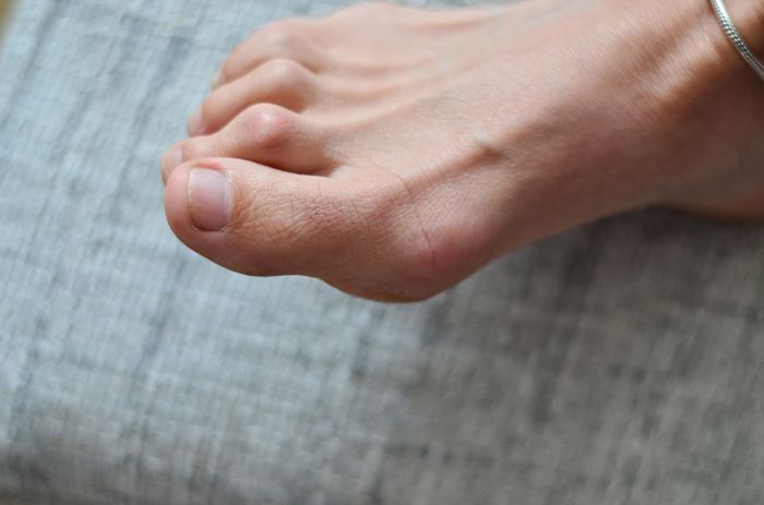 Best Exercises to Improve and Treat Your Hammer Toe main image