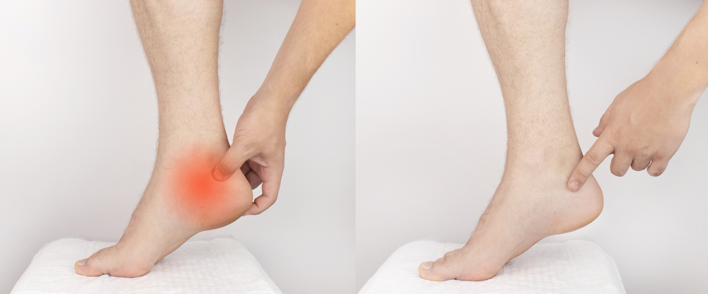 A before and after image of a man with heel spur pain 